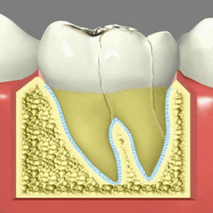 Fractured Tooth